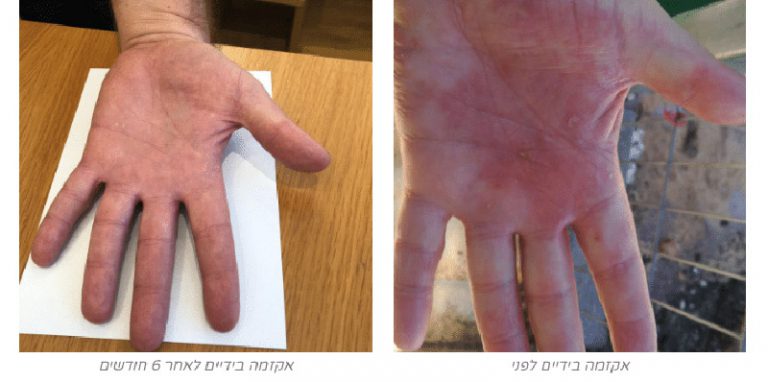מהי מחלת עור דלקתית כרונית? - אמיר קלי מומחה ברפואת עור משלימה