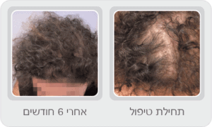 לפני ואחרי טיפול בנשירת שיער לאחר לידה: תחילת הטיפול לעומת אחרי 6 חודשים