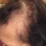 טיפול בנשירת שיער אצל נשים