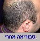 סבוריאה בקרקפת