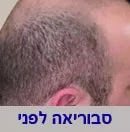 סבוריאה בקרקפת