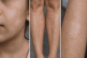Clinical triptych of skin hypopigmentation