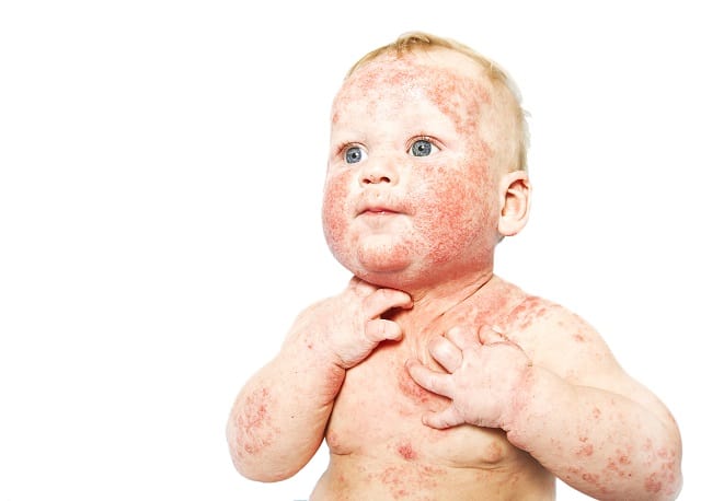 דלקת עור אטופית אצל תינוקות