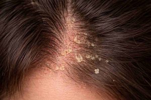 סבוריאה בקרקפת