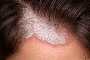 פסוריאזיס בקרקפת