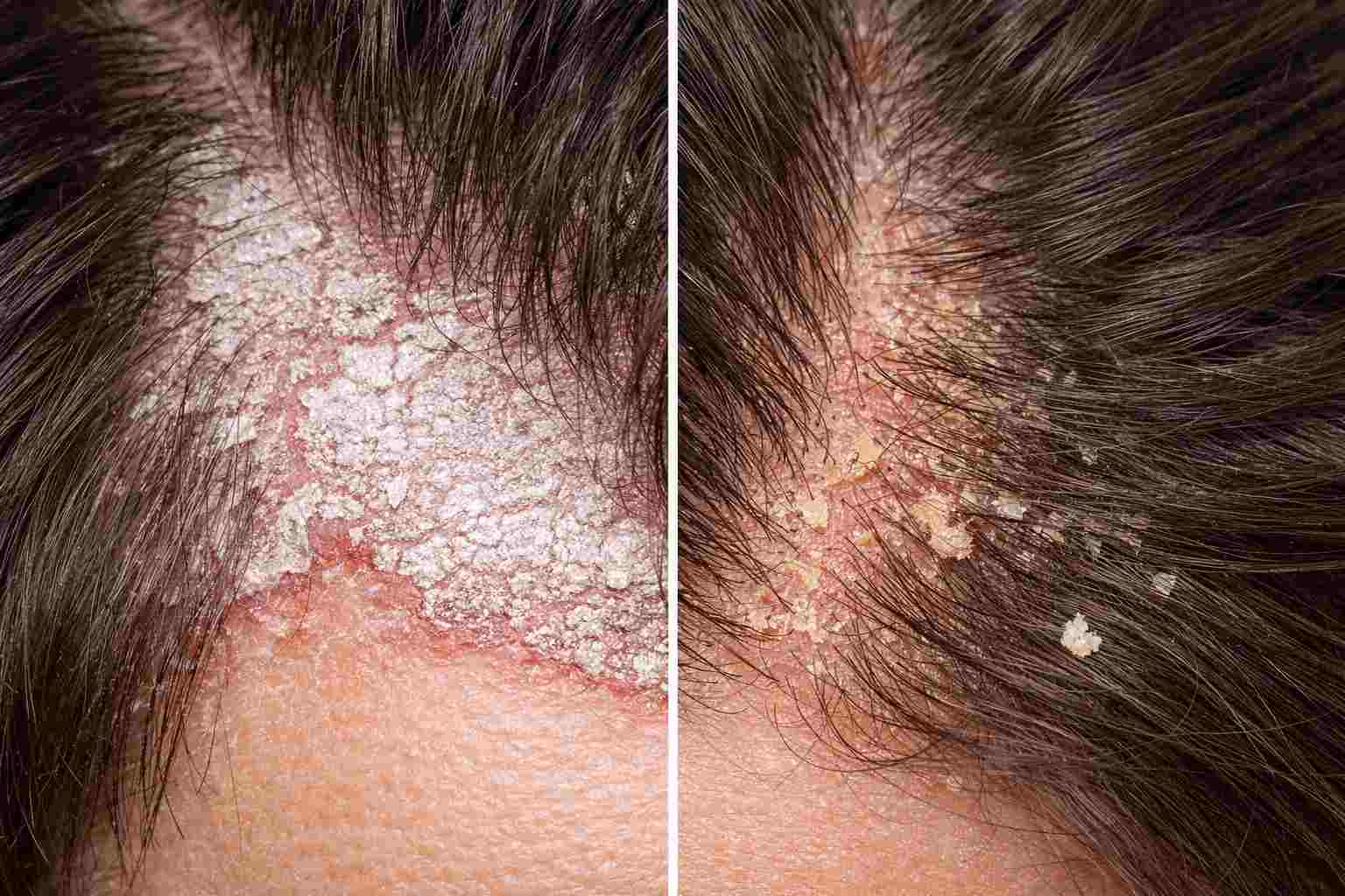 פסוריאזיס בקרקפת או סבוריאה בקרקפת